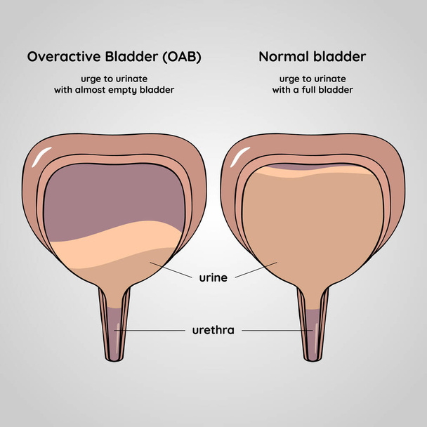 Vessie hyperactive et normale. Maladie du système urinaire. Urologie. Illustration vectorielle plate médicale. - Vecteur, image