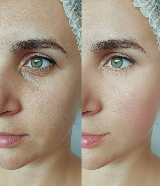 nainen kasvot ryppyjä ennen hoitoa ja sen jälkeen - Valokuva, kuva