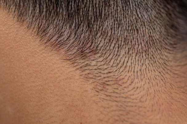 Tinea circinata or ringworm on the head. - Photo, Image