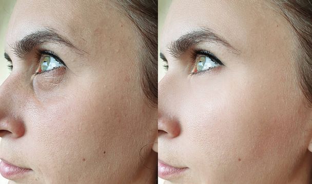 морщины лица женщины до и после лечения - Фото, изображение