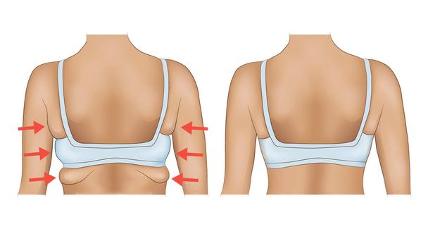 Las axilas de grasa de una mujer con la designación de flecha. Las axilas de grasa antes y después de la dieta o cirugía - Vector, Imagen