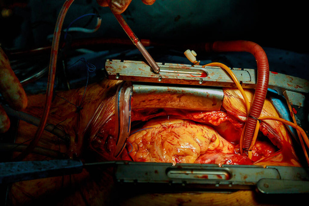 Equipo de cirujanos en injerto de bypass de arteria coronaria hospitalaria para cirugía a corazón abierto - Foto, Imagen