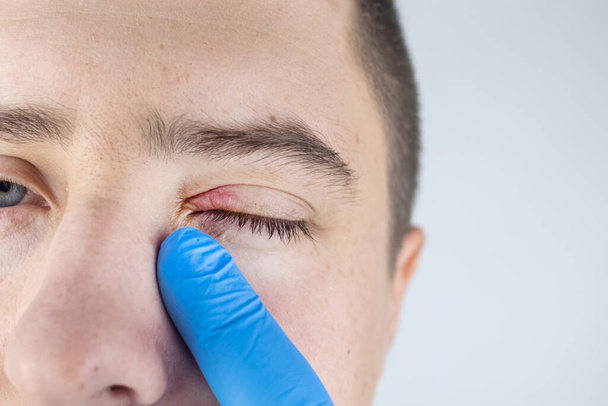 Ένας γιατρός εξετάζει έναν ασθενή που έχει βλεφαρίτιδα. Θεραπεία της φλεγμονής και της ερυθρότητας του βλεφάρου. Μόλυνση του δέρματος γύρω από τα μάτια. Η έννοια της παροχής ποιοτικής ιατρικής περίθαλψης - Φωτογραφία, εικόνα