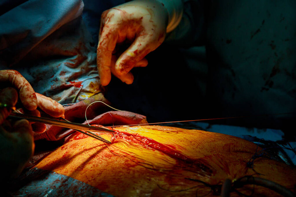 Зашивание кожи после операции на больном пациенте после проведения серьезной операции - Фото, изображение