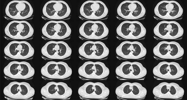 Компьютерная томография легких у здорового взрослого мужчины. КТ легких в норме. Может быть частью диагностики COVID-19. - Фото, изображение