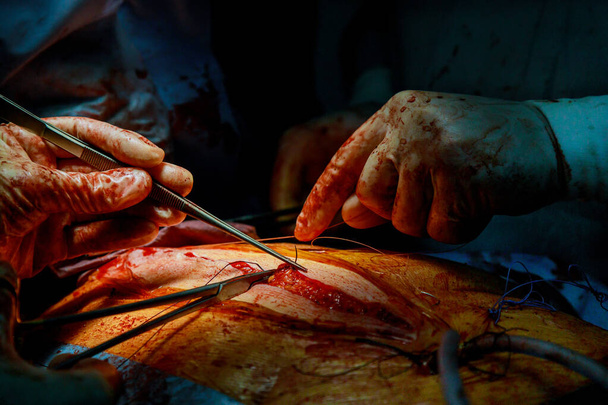 Chirurgen nähten kranken Patienten nach einer schweren Operation an. - Foto, Bild
