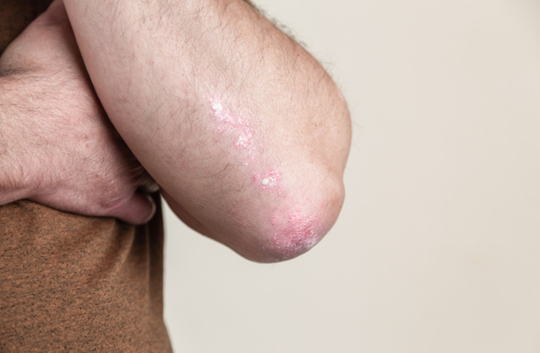 Psoriasis on the elbow. Closeup dermatitis on skin ill allergic rash dermatitis eczema of patient atopic dermatitis symptom skin detail texture, Fungus concept dermatology, treatment fungal and fungal - Photo, Image