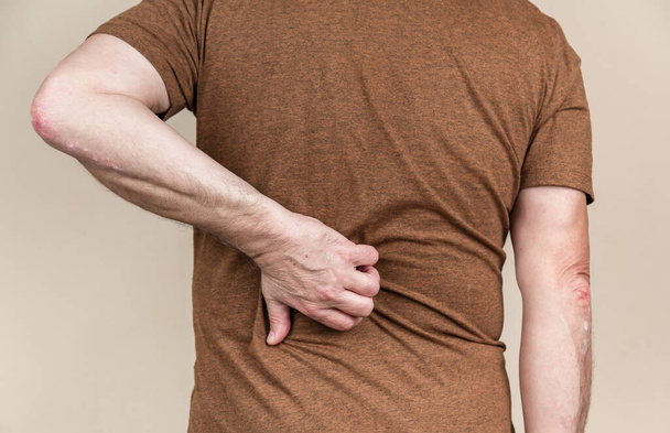 Rückenpsoriasis. Die Hände kratzen den Juckreiz auf dem Rücken. Gesundheits- und Medizinkonzept - Foto, Bild
