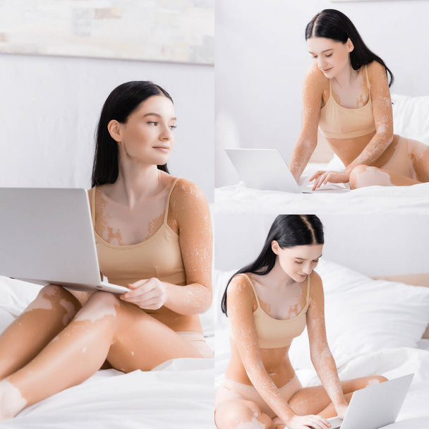 collage van brunette vrouw met vitiligo met behulp van laptop in bed - Foto, afbeelding