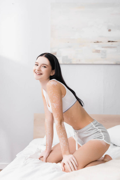 cheerful young woman with vitiligo sitting on bed - Photo, Image