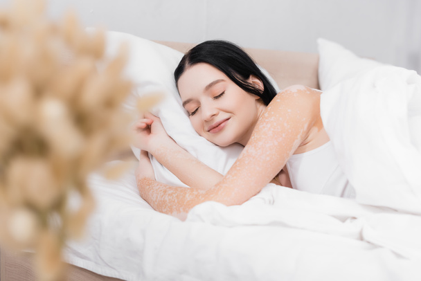 smiling young woman with vitiligo lying on pillow in bed with blurred foreground - Фото, изображение