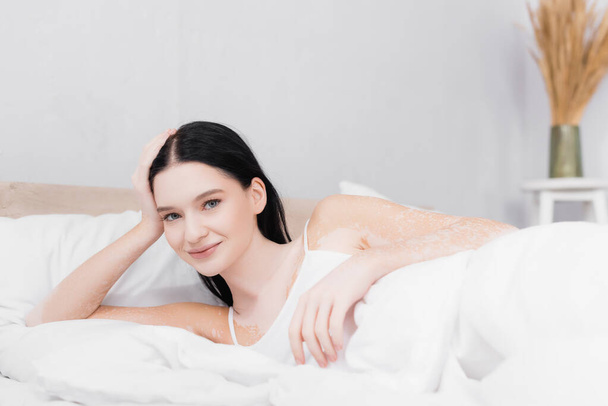 усміхнена молода жінка з вітіліго відпочиває і дивиться на камеру в спальні
 - Фото, зображення
