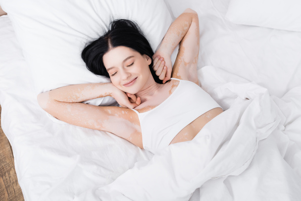 vue du dessus de la jeune femme paresseuse avec vitiligo couché sur le lit  - Photo, image