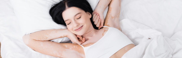 ylhäältä näkymä laiska nuori nainen vitiligo makaa sängyssä, banneri - Valokuva, kuva