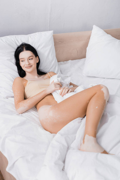 young cheerful woman with vitiligo lying on bed - Foto, Imagen