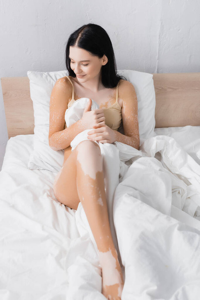 jong gelukkig vrouw met vitiligo zitten op bed - Foto, afbeelding