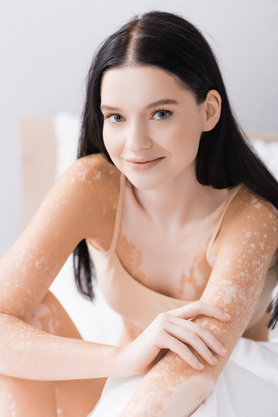 jeune femme positive avec vitiligo regardant la caméra - Photo, image