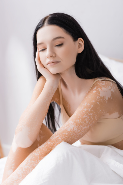 young brunette woman with vitiligo in bedroom  - Fotó, kép