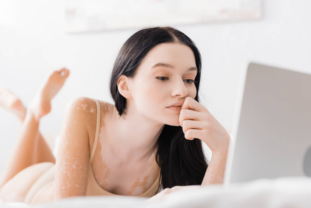 brunette woman with vitiligo lying on bed and looking at laptop  - Φωτογραφία, εικόνα