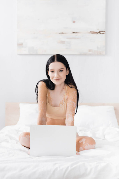brunette woman with vitiligo looking at camera near laptop on bed - Photo, Image