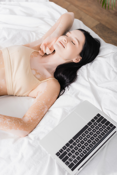 magas szög kilátás barna nő vitiligo pihen az ágyon közel laptop  - Fotó, kép
