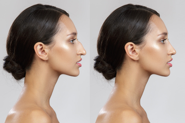 Comparaison du nez féminin après chirurgie plastique. Avant après. Rhinoplastie - Photo, image