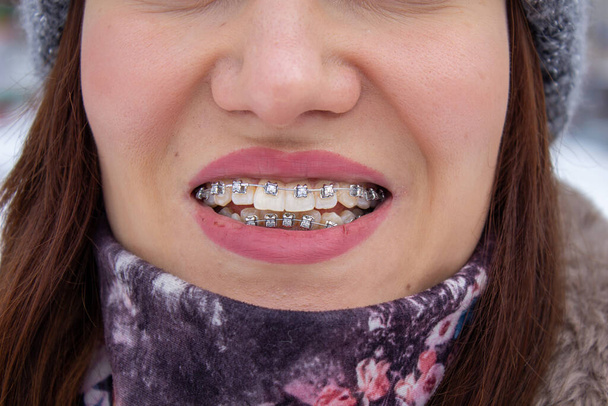 système de joint dans la bouche souriante, macro photo dents, lèvres gros plan,  - Photo, image