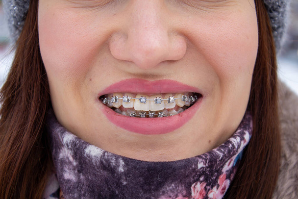 Zahnspangen an den Zähnen der Mädchen, Makrofotorzähne, Lippen in Großaufnahme,  - Foto, Bild