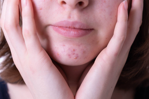 inflammatory and severe acne on the chin of a teenage girl in close-up - 写真・画像