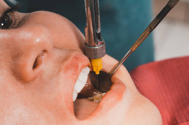 Anestesia local, anestesia, injeção com seringa carpulada, o dentista injeta o paciente.2020 - Foto, Imagem