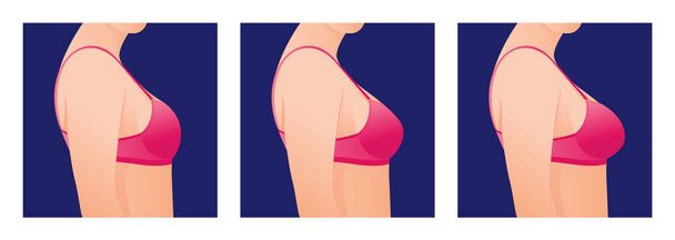 Żeńskie piersi w biustonosz przed i po powiększeniu / korekcji rozmiaru piersi. Koncepcja chirurgii plastycznej.Ciało kobiety zmienia się z nadwagi na szczupłe w wyniku treningu, diety lub treningu fitness. - Wektor, obraz