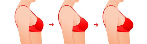 Ženská prsa v podprsence před a po augmentaci / korekci velikosti prsou. Plastická chirurgie koncepce.žena tělo měnící se z nadváhy na štíhlé v důsledku školení, diety nebo fitness cvičení. - Vektor, obrázek