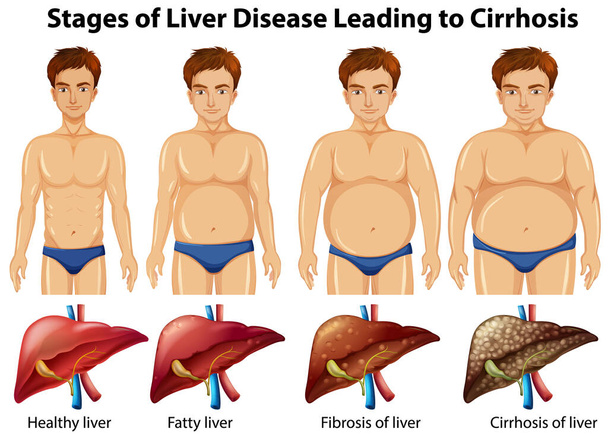 Etapas da doença hepática que levam à ilustração da cirrose - Vetor, Imagem