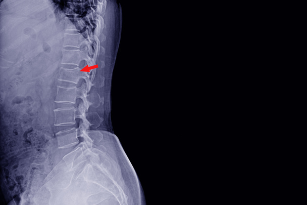 Raggi X Visualizzazioni laterali della colonna vertebrale storia di un incidente maschile e blackpain mostrando compressione frattura del corpo colonna vertebrale L1. Spazi normali del disco e tessuti molli paravertebrali.. - Foto, immagini
