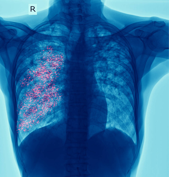 Ακτινογραφία θώρακος που δείχνει κοιλότητα στον δεξιό πνεύμονα και διάμεση διείσδυση και στους δύο πνεύμονες λόγω λοίμωξης από φυματίωση, πνευμονική φυματίωση - Φωτογραφία, εικόνα