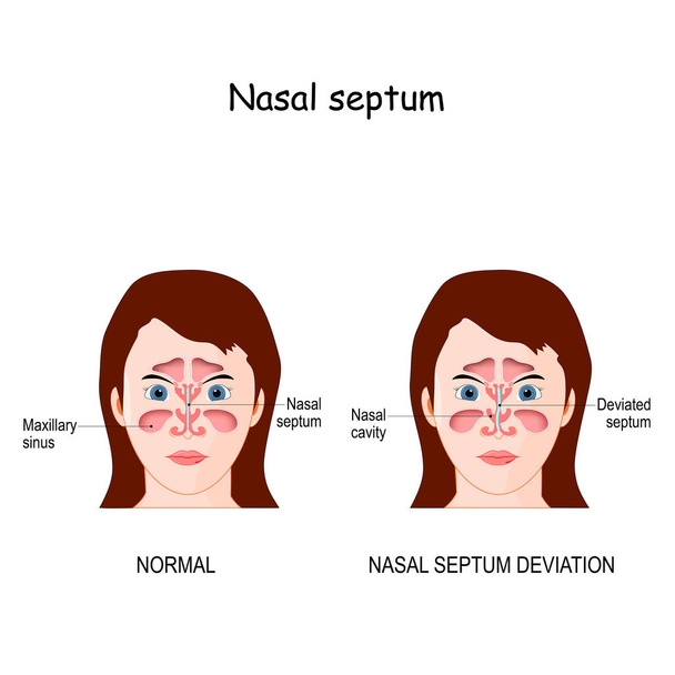 Nasal septum deviation. bone and cartilage in the nose that separates the nasal cavity into the two nostrils. difference and comparison of the nose with a normal and deviated septum - Vector, Image