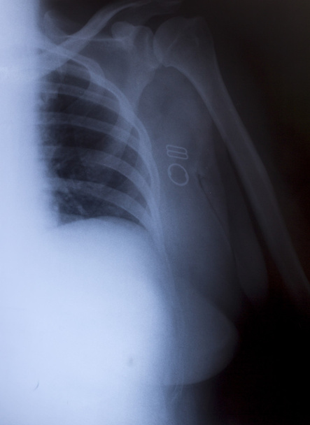X-Ray Image Of Human Chest for a medical diagnosis - Photo, Image