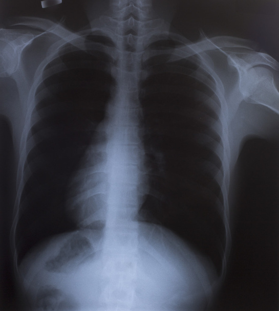 医学診断のための人間の胸の x 線像 - 写真・画像