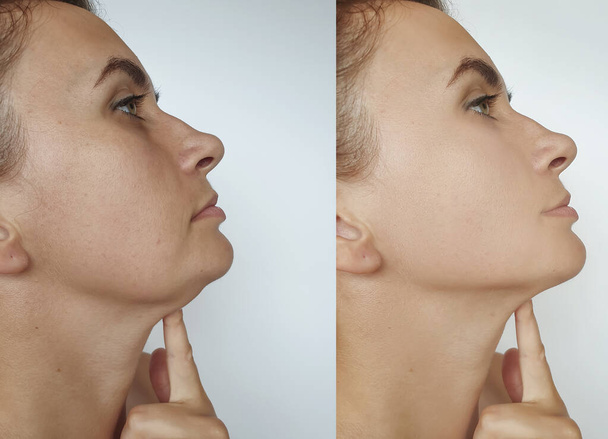 barbilla doble de mujer antes y después del tratamiento - Foto, Imagen