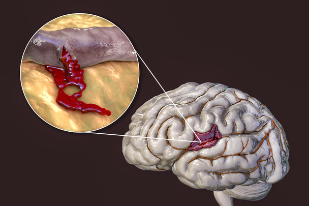 Геморагічний інсульт, 3D ілюстрація, що показує крововилив на поверхню мозку і крупним планом вид кровотечі з судин головного мозку
 - Фото, зображення
