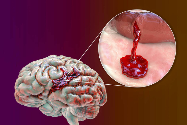 Hemorrhagic stroke, 3D illustration showing hemorrhage on the brain surface and closeup view of the bleeding from a brain blood vessel - Photo, Image