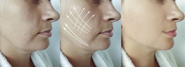 femme double menton avant et après le traitement - Photo, image