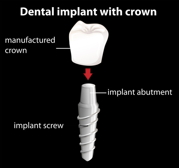 a fogászati implantátum, korona - Vektor, kép