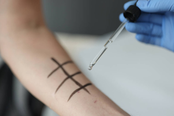 Allergologe träufelt Flüssigkeit mit Pipette auf die Haut von Patienten in Klinik - Foto, Bild