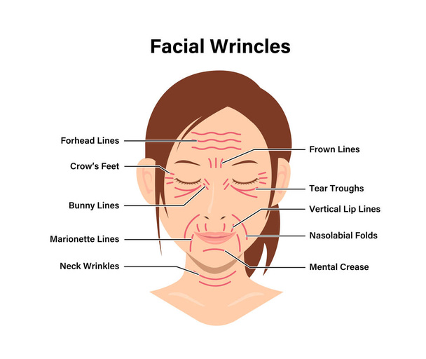 Ilustración de vectores de arrugas faciales (cara femenina) - Vector, Imagen