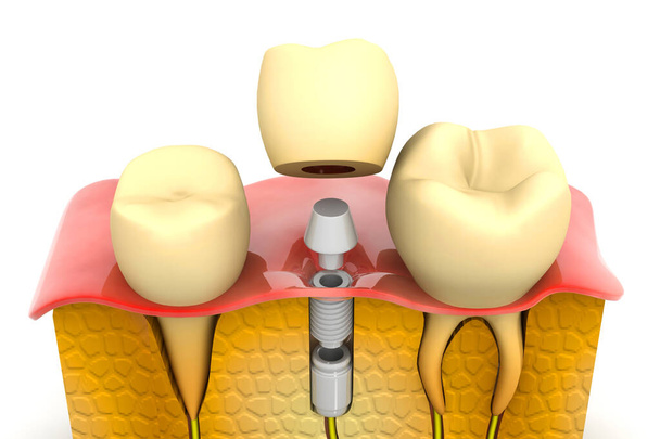 Processo de instalação do implante dos dentes. Renderização 3d - Foto, Imagem