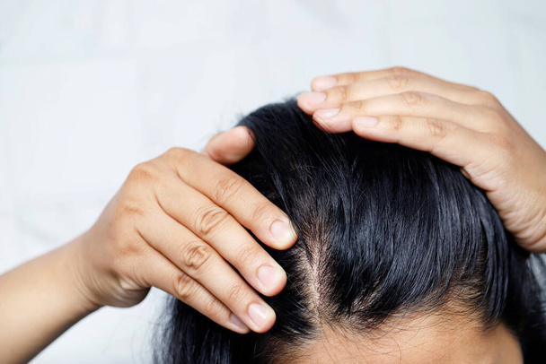 Жінка з випаданням волосся, у неї алергія на шампунь і кондиціонер
. - Фото, зображення
