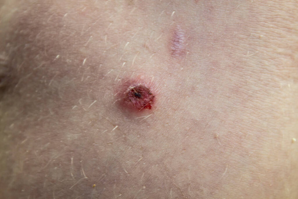 Herida en la rodilla en la pierna del niño. Una cicatriz en la piel del niño. - Foto, Imagen