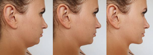 Tedavi öncesi ve sonrası kadınlarda çift çene - Fotoğraf, Görsel
