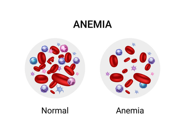 Векторная иллюстрация разности количества здоровых красных кровяных телец. Анемия и норма. - Вектор,изображение